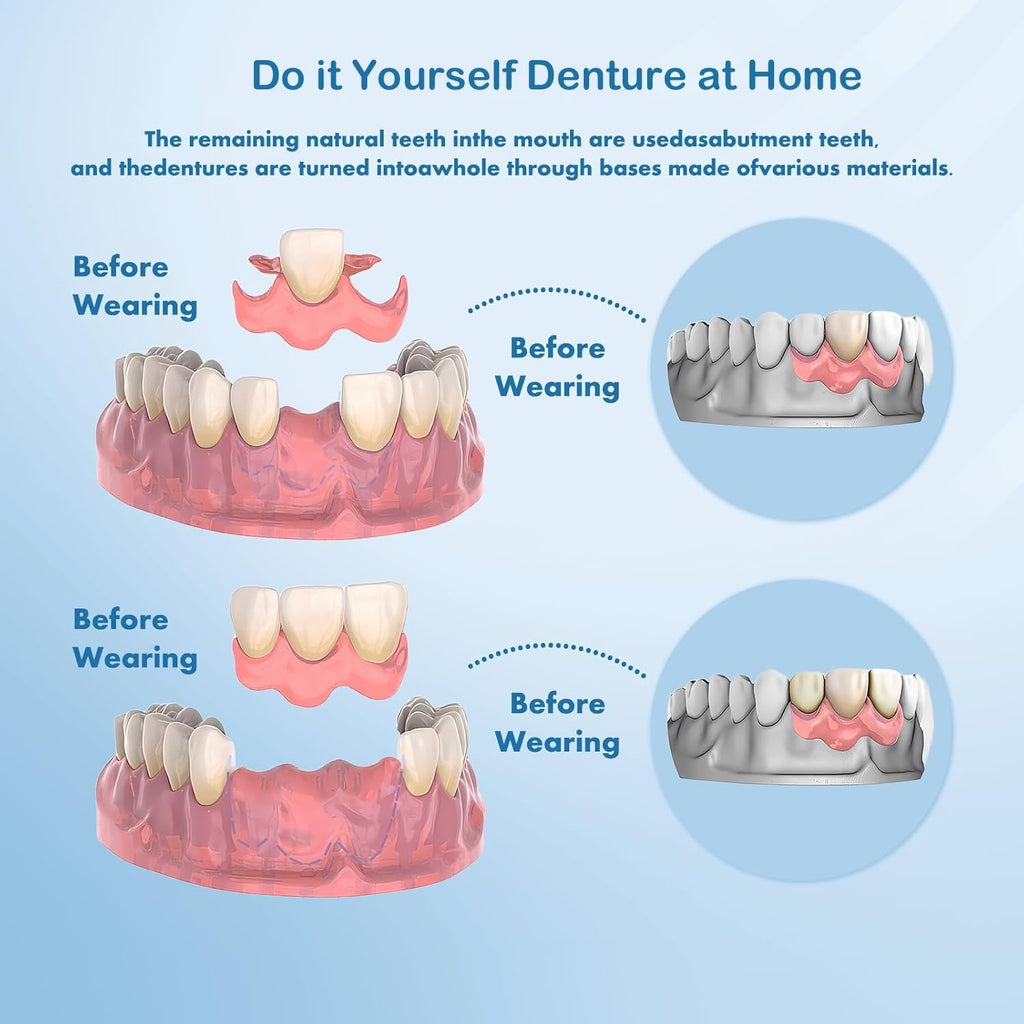 DIY Denture Complete Kit with Impression Material, Gum Material, Components for Top and Bottom Full or Partial Dentures R406238